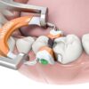 Garrison Composi-Tight®3D Fusion™ MINI KIT