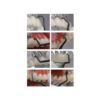 Univerzalni scaler za implantante - 2kom